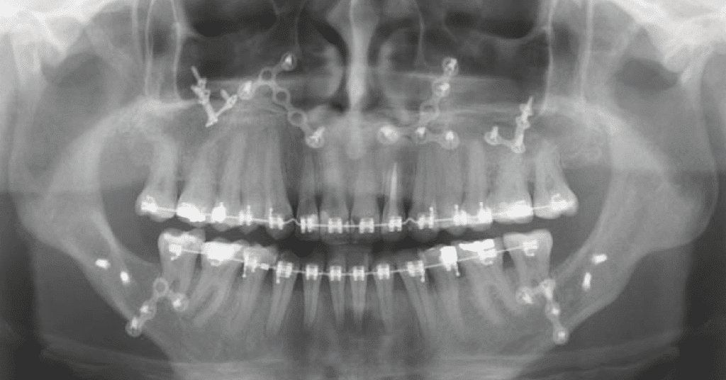 Cirurgia Ortognática